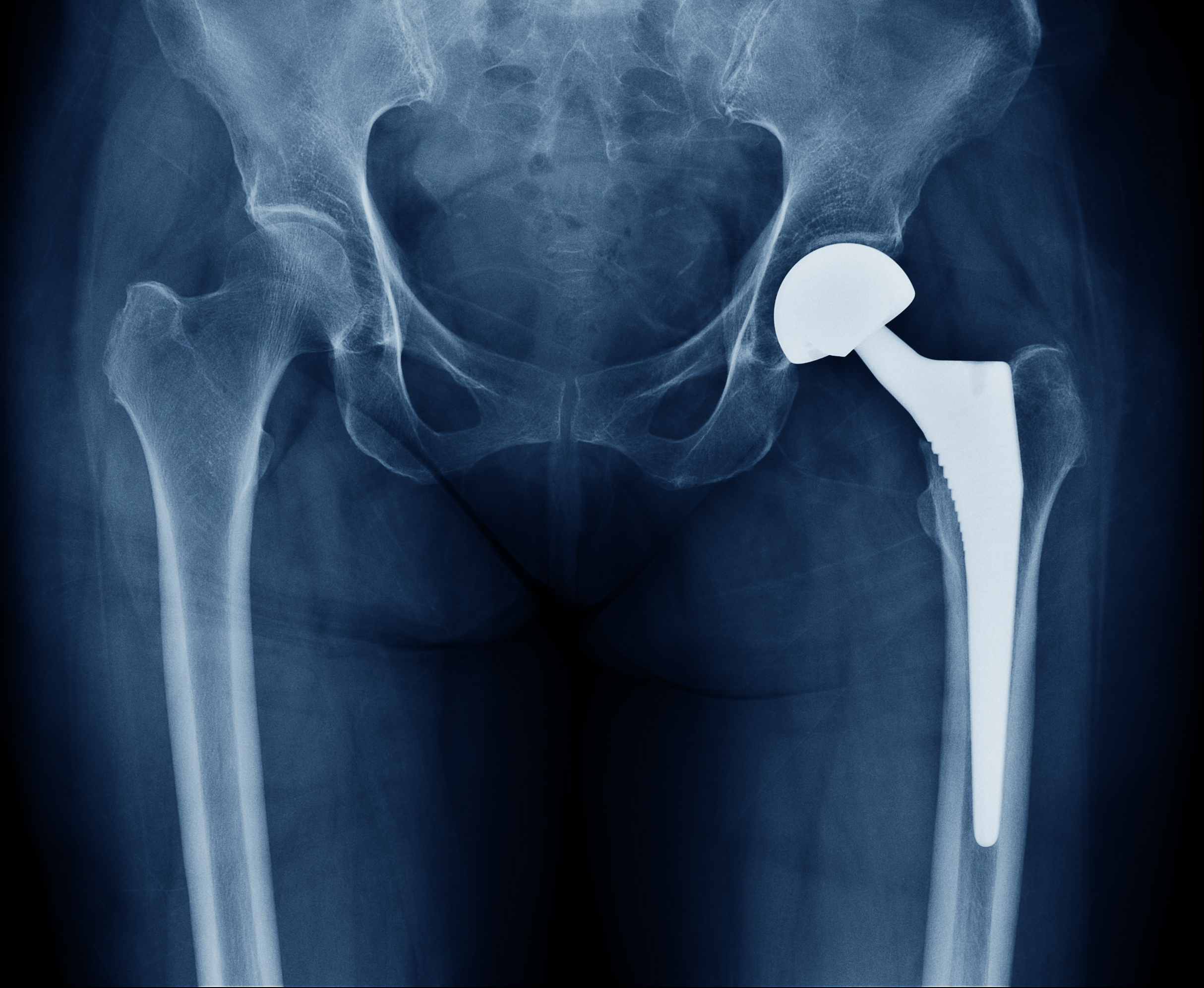 Hip replacement X-ray